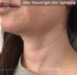 After ThermiTight Skin Tightening