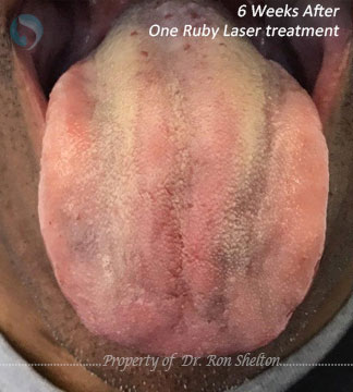 6 weeks after 1 Ruby Laser Treatments