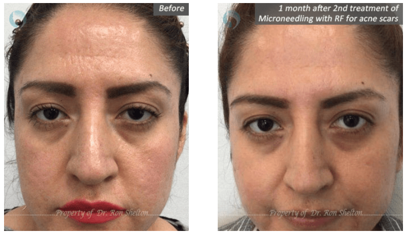 MicroneedlingRF for acne scars