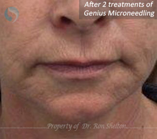 After 2 Treatments of Genius Microneedling