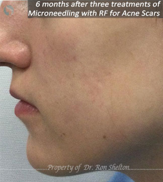 6 months after 3rd treatment of Microneedling with RF for acne scars
