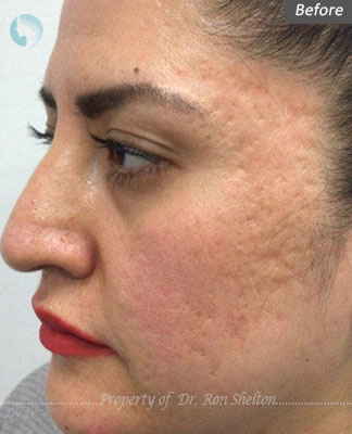 Before Microneedling with RF for Acne scars
