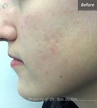 Before Microneedling with RF for Acne scars