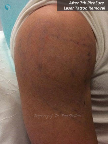 After 7th PicoSure Laser Tattoo Removal