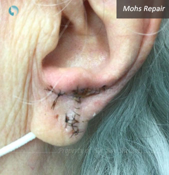 Mohs Repair on ear lobe