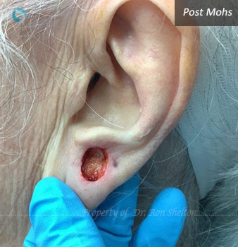 Post Mohs on ear lobe