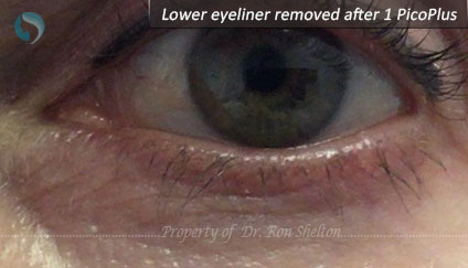 Lower Eyeliner Removed After 1 PicoPlus