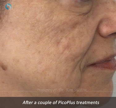 After a couple of PicoPlus treatments