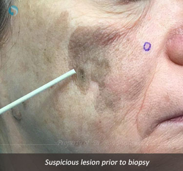 Suspicious lesion prior to biopsy