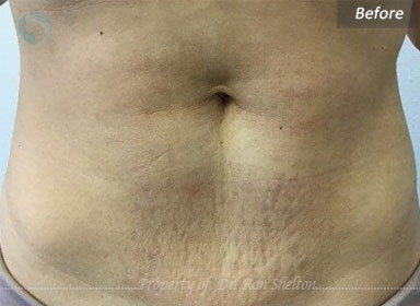 stretch marks before Microneedling RF