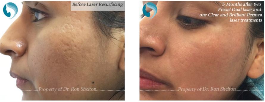 acne scar removal nyc with fraxel