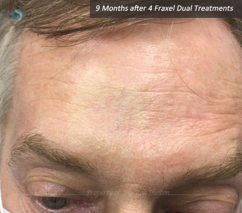 9 Months after 4 Fraxel Dual Treatments