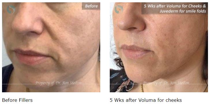 juvederm fillers nyc