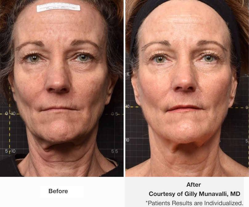 Sofwave™ non-surgical facial lifting in NYC