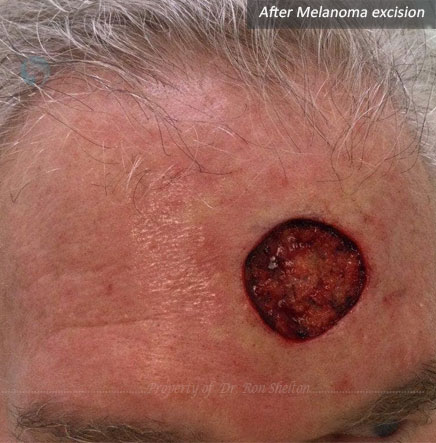 After Melanoma excision