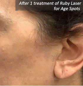 After 1 Treatment of Ruby Laser for Age Spots