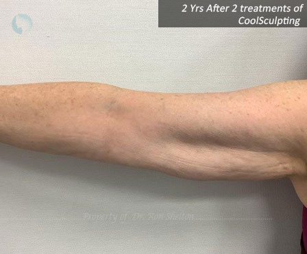 2 Years after 2 Treatments of CoolSculpting