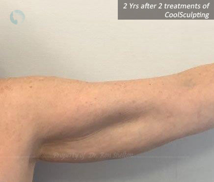 2 years after 2 treatments of CoolSCulpting