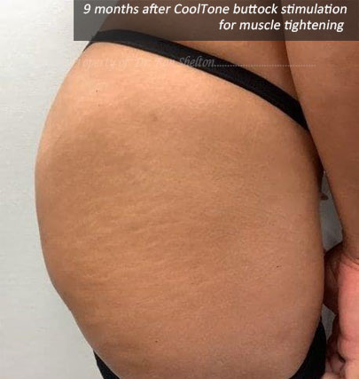 9 months post series of CoolTone Buttock Muscle Stimulation for muscle tightening