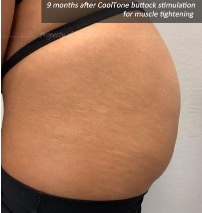 9 months post series of CoolTone Buttock Muscle Stimulation for muscle tightening