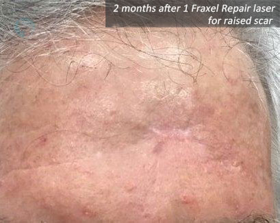 2 months after 1 Fraxel Repair laser for raised scar