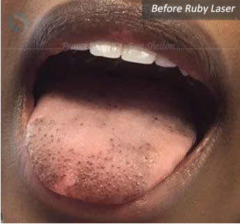 Before Ruby Laser for tongue pigmentation