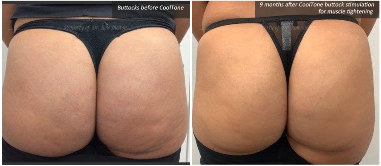 Cooltone treatment body sculpting nyc
