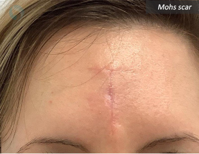 Mohs scar before treatment