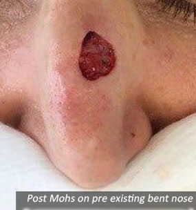 Post Mohs on pre existing bent nose.