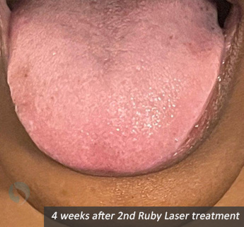 4 weeks after 2nd Ruby Laser treatment