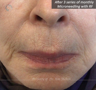 After series of 3 monthly Microneedling with RF