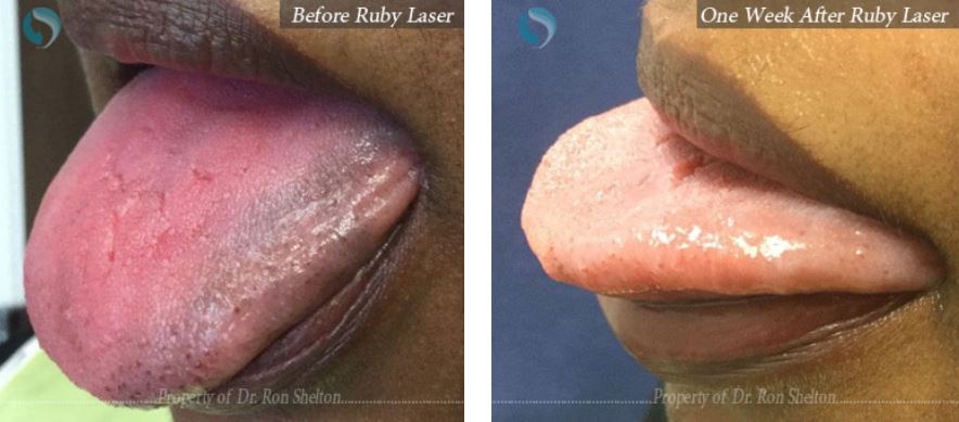 Ruby laser for dark spots on tongue
