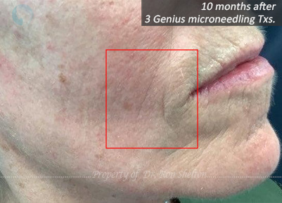10 months after 3 Before Genius Microneedling for perioral lines