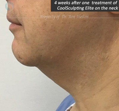 4 weeks after one  treatment of  CoolSculpting Elite on the neck