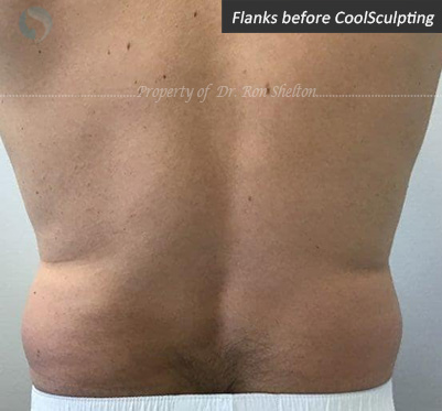 Before CoolSculpting for flanks