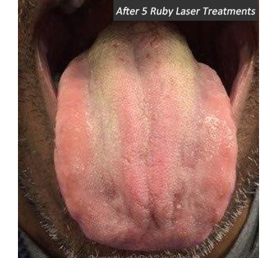After 5 Ruby Laser treatmentsAfter 5 Ruby Laser treatments