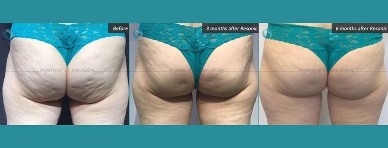 https://www.thenyac.com/wp-content/uploads/2023/03/Patient-in-her-60s-before-and-3-months-and-6-months-after-Resonic-for-cellulite-min.jpg