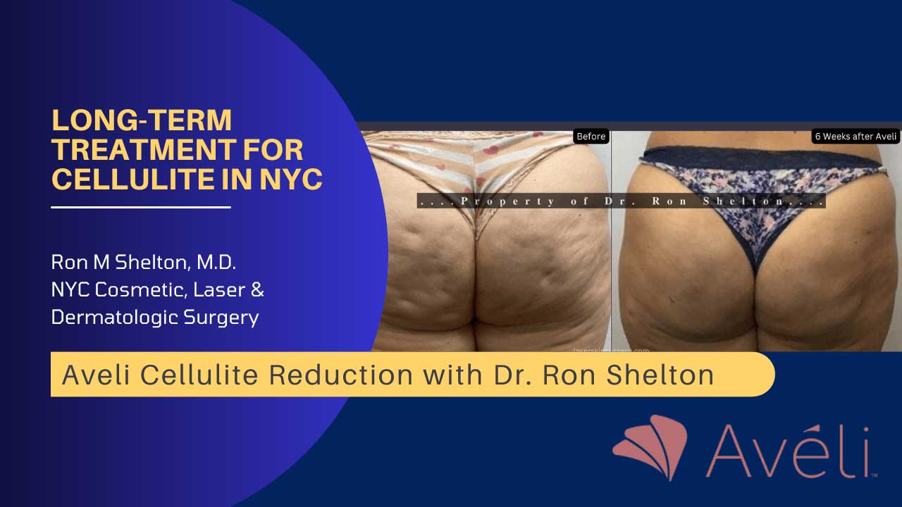 Avéli™ Long-Term Treatment for Cellulite in NYC