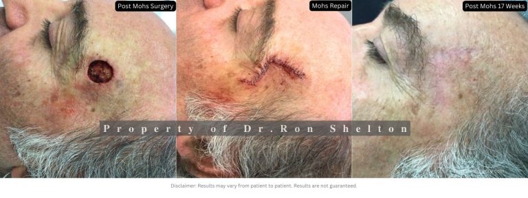 Mohs surgery before and after 17 weeks