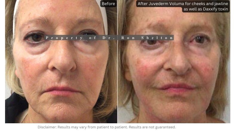 Post filler with four syringes of Juvederm Voluma for cheeks and jawline to hide the jowls which had fallen over her jawline. She also had Daxxify toxin