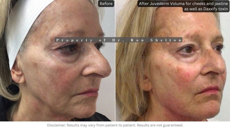 Post filler with four syringes of Juvederm Voluma for cheeks and jawline to hide the jowls which had fallen over her jawline. She also had Daxxify toxin