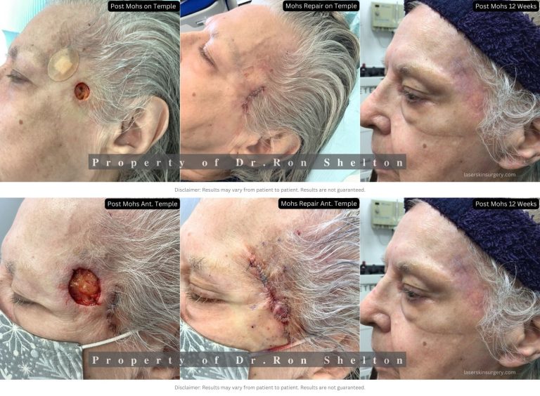 Two separate Basal Cell Carcinomas removed within 2 weeks of each other to allow for better aesthetic results. Closing one wound and allowing healing then doing Mohs surgery on the other allows for 2 distinct closures rather than one large defect which might have needed a skin graft with less than a desirable cosmetic result. This scar is only 3 months old and new blood vessels formed giving it a red color but they will fade or can be treated by laser. The scar is almost imperceptible as a fine line.
