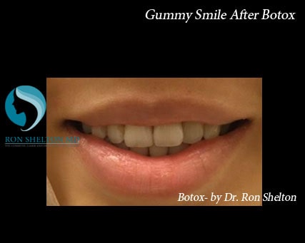 Gummy Smile Before Botox